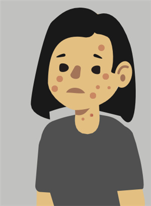 Girl in a gray shirt with spots on her face indicating a rash symptom.