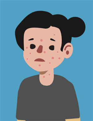 Girl who appears to be upset with small pink dots on her face indicating chicken pox